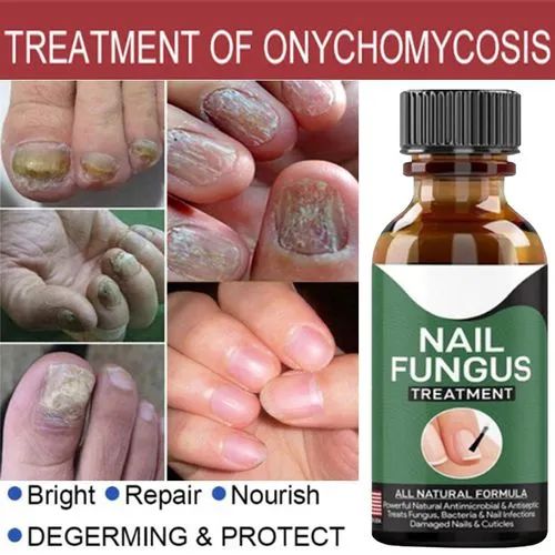 Fast Nail Fungal Treatment Serum – Nail Repair Essence for Fungus Removal & Healthy Nails