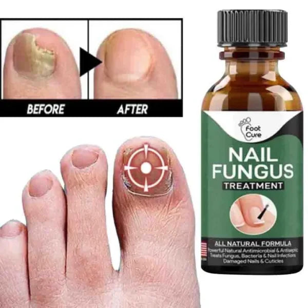 Fast Nail Fungal Treatment Serum – Nail Repair Essence for Fungus Removal & Healthy Nails